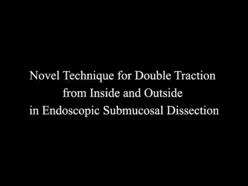 Novel Technique for Double Traction from Inside and Outside in Endoscopic Submucosal Dissection