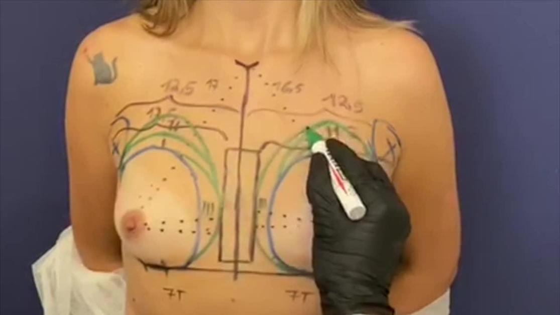 Tight Cleavage without Symmastia: Fat Grafting and Implants for the Perfect  Breast Augmentation - Visage Cosmetic Plastic Surgery