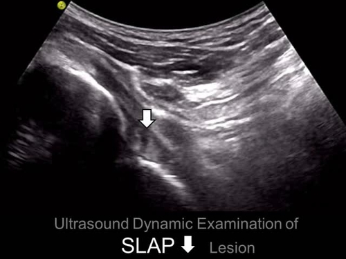 Dynamic Ultrasound Imaging for the Diagnosis of  Superior Labrum Anterior to Posterior (SLAP) Lesion
