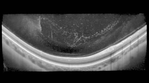 IMAGING THE VITREOUS WITH A NOVEL BOOSTED OPTICAL COHERENCE TOMOGRAPHY TECHNIQUE: Vitreous Degeneration and Cisterns (Video 1)