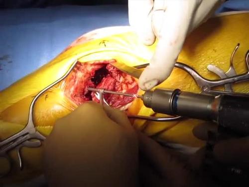 Repair of Displaced Partial Articular Fracture of the Distal Femur: The Hoffa Fracture