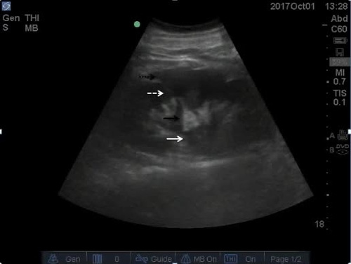 POC ultrasound kidneys--video 3
