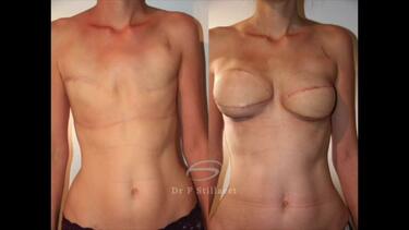 Will There Be Sagging Again After Breast Lift Surgery? » Op. Dr. Evren İşçi