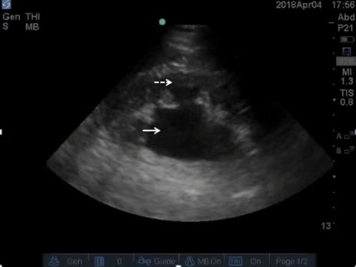 POC ultrasound kidneys--video 4
