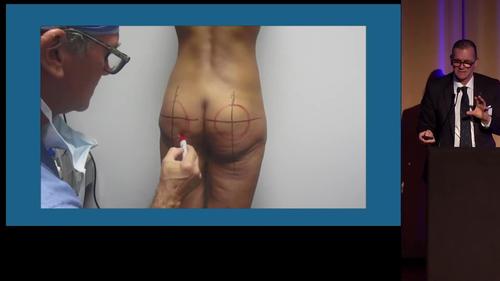 Buttock Augmentation, New Orleans, Oculo Plastic Surgery, Marilyn Pelias,  MD, FACS