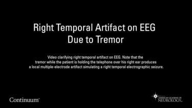 Right temporal artifact on EEG due to tremor