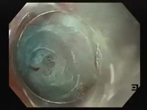 “Inverted” endoscopic submucosal dissection after submucosal tunneling for the resection of superficial submucosal lesions