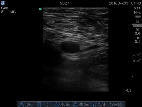 POC ultrasound shock--video 4