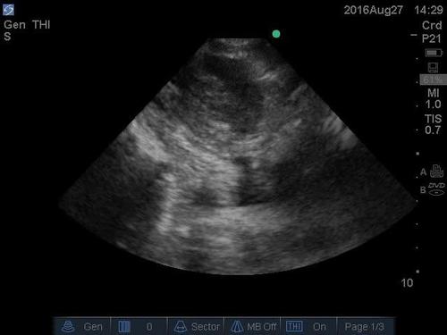 POC ultrasound shock--video 9