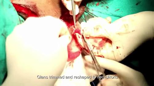 Male to female surgery. Video from “Sigma Lead Male-to-Female Gender Affirmation Surgery: Blending cosmesis with functionality”