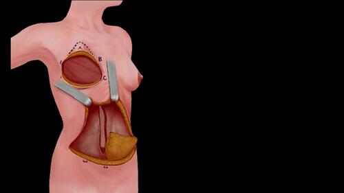 Raising the Abdominal Flap – Final Stage. Video 5 from “A Safe and Efficient Technique for Pedicled TRAM Flap Breast Reconstruction” June 2023 – 151 (6) CME