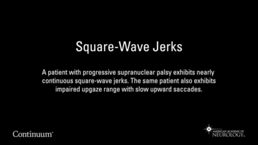 Square-Wave Jerks
