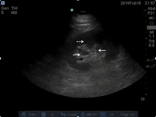 POC ultrasound kidneys--video 2
