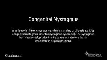 Congenital Nystagmus