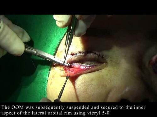 Orbicularis oculi muscle suspension. Video 6 from “Rejuvenation of the lower eyelid and midface with deep nasolabial fat lift in East Asians.” 151(6).