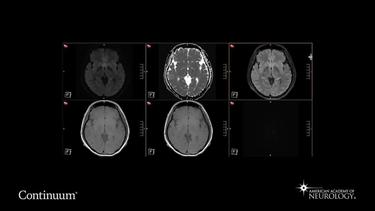 Brain MRI in a patient with new-onset super-refractory status epilepticus.