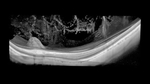 IMAGING THE VITREOUS WITH A NOVEL BOOSTED OPTICAL COHERENCE TOMOGRAPHY TECHNIQUE: Vitreous Degeneration and Cisterns (Video 6)