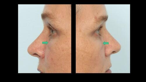 Pre-Op Assessment. Video 1 from “Mid Cheek Lift via the Facial Soft Tissue Spaces.” 151(6).