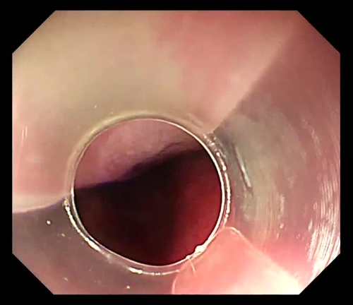 Endoscopic full length mucosa incision for a huge esophageal hematoma therapy: the first clinical experience