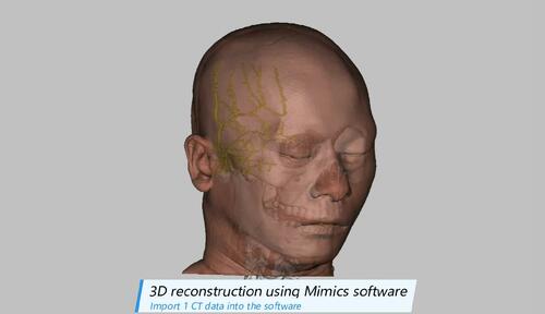 3D Reconstruction of Zygomatico-orbital Artery