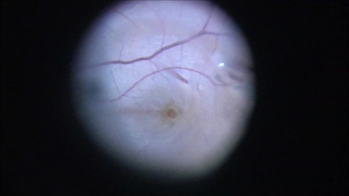 MACULAR HOLE HYDRODISSECTION