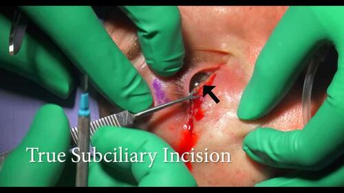 Skin Flap Elevation. Video 2 from “Mid Cheek Lift via the Facial Soft Tissue Spaces.” 151(6).