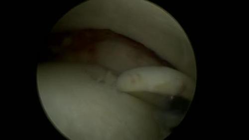 Ankle Fracture Arthroscopy