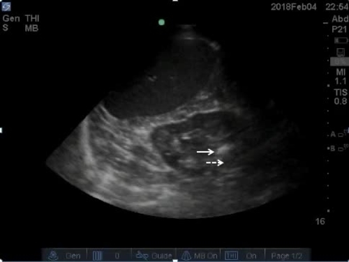 POC ultrasound kidneys--video 5