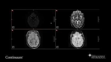Brain MRI in a patient with postanoxic status epilepticus.