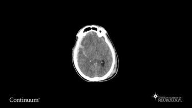 Admission head CT in a patient with severe traumatic brain injury.