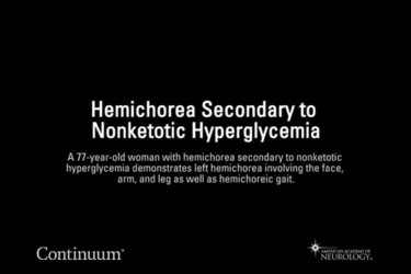 Hemichorea secondary to nonketotic hyperglycemia