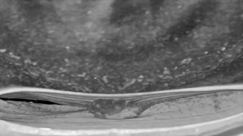 IMAGING THE VITREOUS WITH A NOVEL BOOSTED OPTICAL COHERENCE TOMOGRAPHY TECHNIQUE Posterior Vitreous Detachment (Video 3)