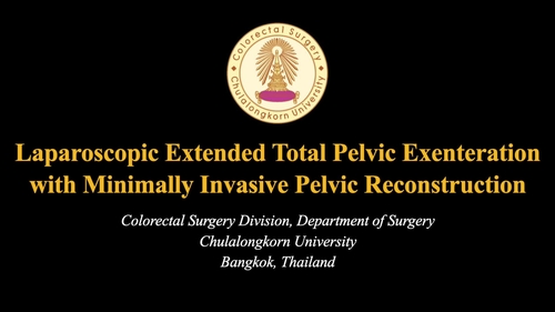 Laparoscopic Extended Total Pelvic Exenteration with En bloc Penectomy with Minimally Invasive Mucosal Removal Sigmoid Flap Pelvic Reconstruction for T4 Rectal Cancer