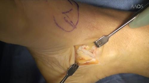 Surgical Correction of Drop Foot by Posterior Tibialis Transfer