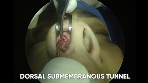 Development of preservation rhinoplasty in mestizo noses. Video 1 from “Preservation Rhinoplasty: A New Approach to Mestizo Noses.”
