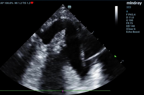 February 2023: A Modest Aortic Dissection Proposal: More Ultrasound is Better