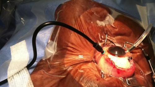 An Optimized Technique for Peripheral Vitreoretinal Surgery With Chandelier Endoillumination