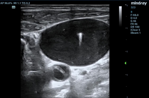 February 2023: A Modest Aortic Dissection Proposal: More Ultrasound is Better