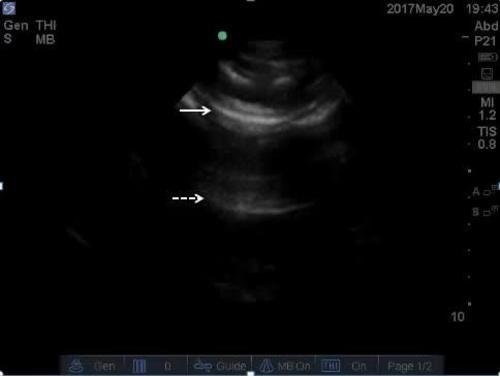 POC ultrasound shock--video 2