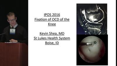 Fixation of OCD of the Knee - POSNAcademy