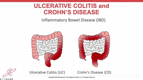 Thumbnail for Unit 6 Recorded Lecture Part 3 UC &amp; Crohn's Disease