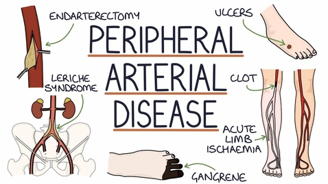 Thumbnail for HTHS 2231 Pathology of the Cardiovascular System Understanding Peripheral Arterial Disease Video with Questions