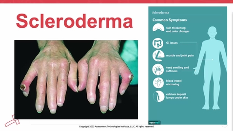 Thumbnail for Unit 13 Recorded Lecture Part 3 Scleroderma &amp; Gout