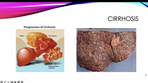 Thumbnail for Liver Cirrhosis and Cirrhosis complications
