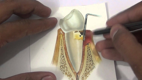 Thumbnail for entry HTHS 2231: Gingivitis and Periodontitis Stages Video with Questions