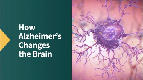 Thumbnail for HTHS 2231 Nervous Pre-Lab: Alzheimer Disease Video with Questions