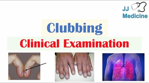 Thumbnail for entry HTHS 2231 Respiratory: Clubbing &amp; Schamroth’s Sign Video with Questions