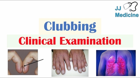 Thumbnail for HTHS 2231 Respiratory: Clubbing &amp; Schamroth’s Sign Video with Questions