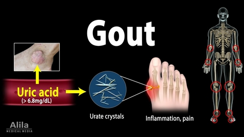 Thumbnail for HTHS 2231 Musculoskeletal: Gouty Arthritis Video with Questions