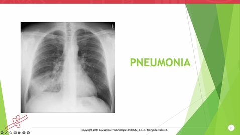 Thumbnail for Unit 4 Recorded Lecture Part 3 Pnuemonia &amp; Cystic Fibrosis